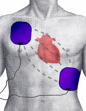 position des electrodes pour la defibrillation